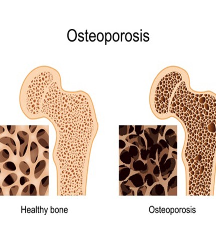 Vitalstoffkur: Osteoporose  